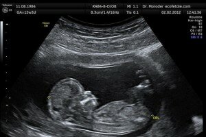 fetus-pic510-510x340-10322